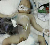 Có phải bác sỹ tuột tay làm bé sơ sinh bị lòi ruột và tử vong?