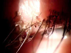 Clip: Cận cảnh đàn rận lúc nhúc trên mí mắt người phụ nữ