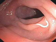 Loại giun kí sinh người Việt dễ mắc và cách phòng tránh