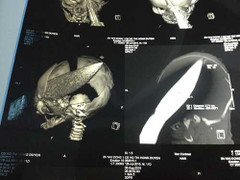 Bé trai 12 ngày tuổi bị đâm xuyên đầu: Những tình tiết rúng động dư luận