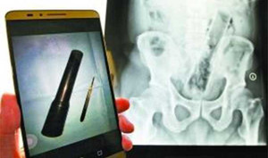 Xi lanh dài bằng cái thước trong trực tràng: Bệnh nhân kiên quyết giấu nhẹm