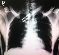 Trộm chó bắn thủng ngực dân quân tự vệ bằng tên điện