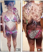 Bệnh lạ khiến thiếu nữ có làn da như da báo