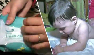 Khăn ướt làm bé 6 tháng tuổi bỏng nặng