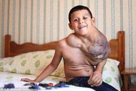 Ca phẫu thuật kỳ diệu cứu cậu bé có khối u bằng quả bóng