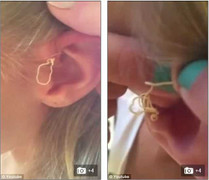 Kinh hãi nhìn cảnh nặn mụn ở tai