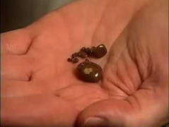 Tống sỏi thận ra ngoài dễ dàng không cần phẫu thuật