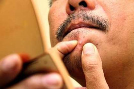 Thực hư tin lan truyền nam thanh niên Hà Nội chết vì nặn mụn