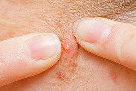 Tự nặn mụn khiến nhiễm trùng máu: Gia đình xin về nhà lo hậu sự