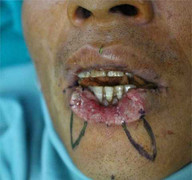 Quý ông uống rượu, thách nhau nên bị bạn cắn đứt môi