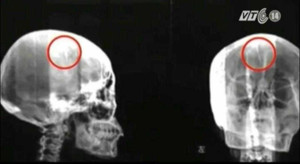 Phát hiện kim dài 5cm trong não suốt 46 năm