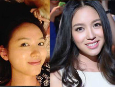 Tử vong vì nhiễm trùng do nặn mụn