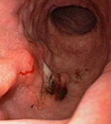 Viêm loét dạ dày và những biến chứng nguy hiểm khôn lường