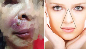 Bằng chứng vùng 'tam giác tử thần' trên mặt là có thật