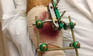 Án phạt nặng hơn vụ Quế Ngọc Hải, Đình Đồng: Đạp gãy chân đối thủ, lãnh án tù 1 năm