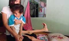 Thành công ghép tế bào gốc chữa bại não