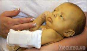 Cách nhận biết vàng da bệnh lý hay sinh lý