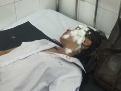 Nữ sinh bị tạt axit, hung thủ ra tay trong 30 giây