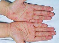 Hi hữu người lớn mắc tay chân miệng