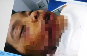 Bé gái 8 tuổi bị chó nhà cào cắn thương tâm