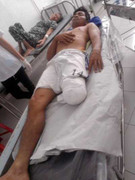 Va phải cầu sắt, nam thanh niên đứt lìa cẳng chân