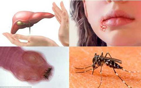 Không đánh giá đúng trạng thái người mang virus: Nguy cơ ung thư gan cao