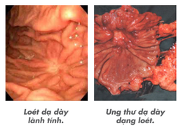 Người phụ nữ thoát khỏi viêm loét, polip dạ dày một cách ngoạn mục