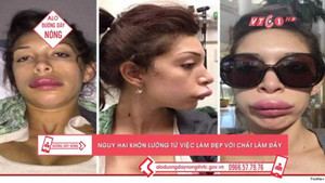 Sưng môi, lệch cằm vì tiêm filler làm đẹp