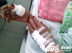 Bị từ chối ngủ chung, chồng chém vợ lìa ngón tay