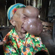 Xin cứu người đàn bà có khối u trên mặt căng như quả bóng chực nổ tung