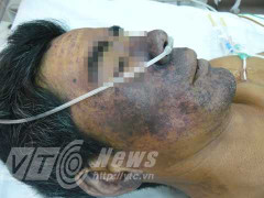 10 người chết do sử dụng thịt lợn không đúng cách