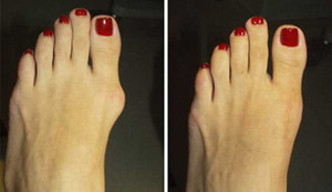 Loại bỏ u biến dạng ở khớp ngón chân cái