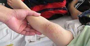 Thực hư chủng virus 'ăn cơm thủng ruột'