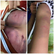 Người cha nhẫn tâm đánh con gái ruột bầm dập khắp người