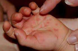 Thuốc điều trị tay chân miệng từ lá trầu