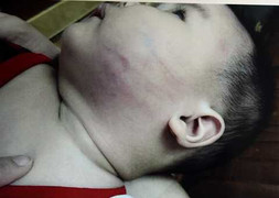 Bé trai 8 tháng tuổi nghi bị đánh bầm tím ở nhà gửi trẻ