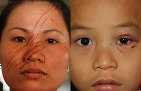 Hàng xóm côn đồ rạch nát mặt mẹ, đánh bầm mắt con