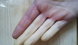 Nếu tay thường xuyên lạnh lẽo, có thể bạn đã mắc 1 trong 5 bệnh sau