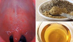 Viêm họng dai dẳng đến mấy, dùng bài thuốc này chỉ 4 giờ là khỏi