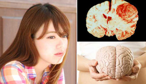 Đau đầu kiểu này phải cảnh giác kẻo mắc bệnh u não