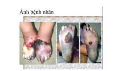 Trời lạnh, hoại tử mất chân tay như chơi