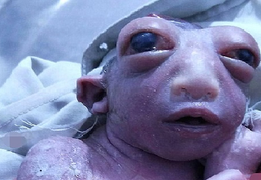 'Cô bé ngoài hành tinh' tử vong sau hai ngày chống chọi tử thần