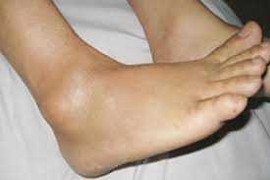 Cách xử trí bong gân nhanh gọn