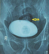 Bệnh lạ gì khiến bệnh nhân ăn gì tiểu ra cái ấy?