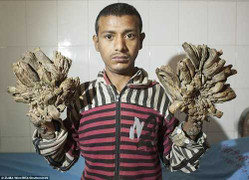 Người đàn ông 'mọc rễ' ở tay, chân tại Bangladesh