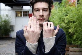 Cắt ngón chân ghép lên ngón tay để nuôi mộng làm diễn viên nổi tiếng