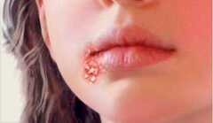 Mụn rộp ở môi – phải làm sao?