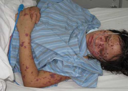 Cục trưởng Y tế dự phòng nói cách tránh mắc viêm não mô cầu