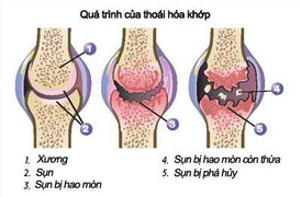 Phòng chống và điều trị bệnh thoái hóa khớp