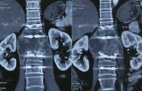 Lần đầu tiên thay 2 đốt sống nhân tạo tại BV Đại học Y Hà Nội